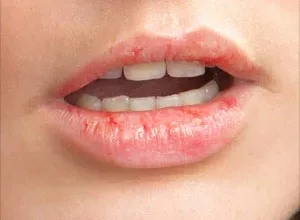 1659034280_Hausmittel-fuer-rissige-Lippen