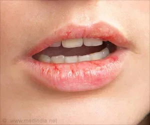 Hausmittel für rissige Lippen