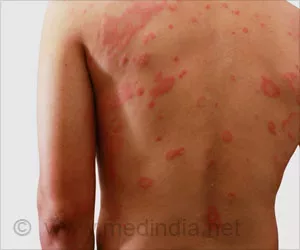Hausmittel für Dermatitis