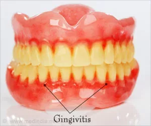 Hausmittel gegen Gingivitis