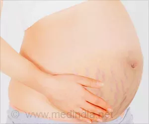 Wie man Schwangerschaftsstreifen natürlich loswird