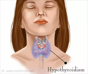 Top 10 Hausmittel zur Behandlung von Hypothyreose