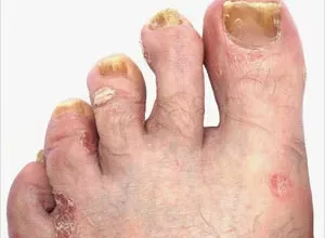 1660247480_Hausmittel-gegen-Nagelpilz