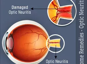 1660355839_Hausmittel-fuer-Optikusneuritis