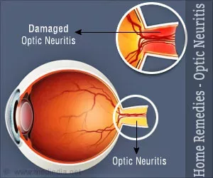 Hausmittel für Optikusneuritis