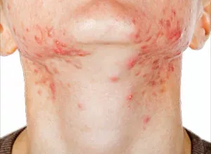 1660507518_Hausmittel-gegen-stachelige-Hitze-Schweissausschlag