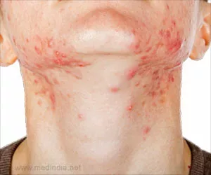 Hausmittel gegen stachelige Hitze / Schweißausschlag