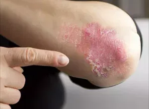 1660529195_Einige-der-besten-Hausmittel-fuer-Psoriasis