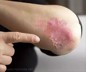 Einige der besten Hausmittel für Psoriasis