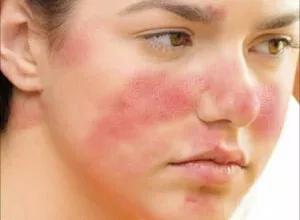 1660659141_Hausmittel-gegen-Rosacea