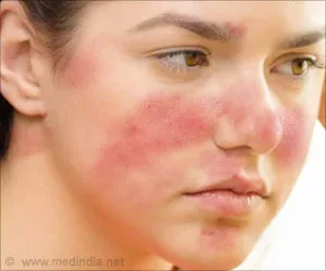 Hausmittel gegen Rosacea