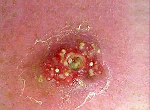 1660789095_Hausmittel-fuer-Staph-Infektion