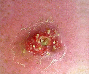 Hausmittel für Staph-Infektion