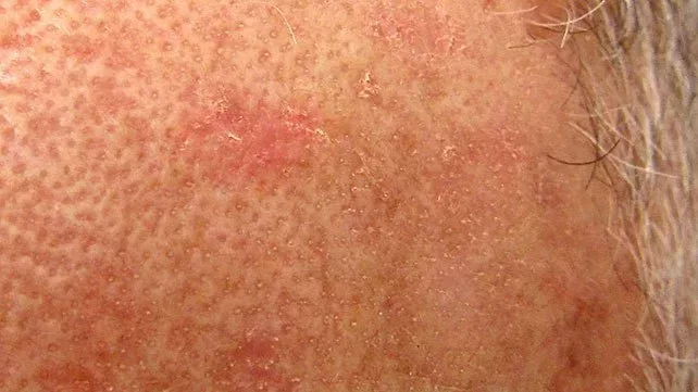 10 unglaubliche Hausmittel gegen Aktinische Keratose, die Sie kennen sollten
