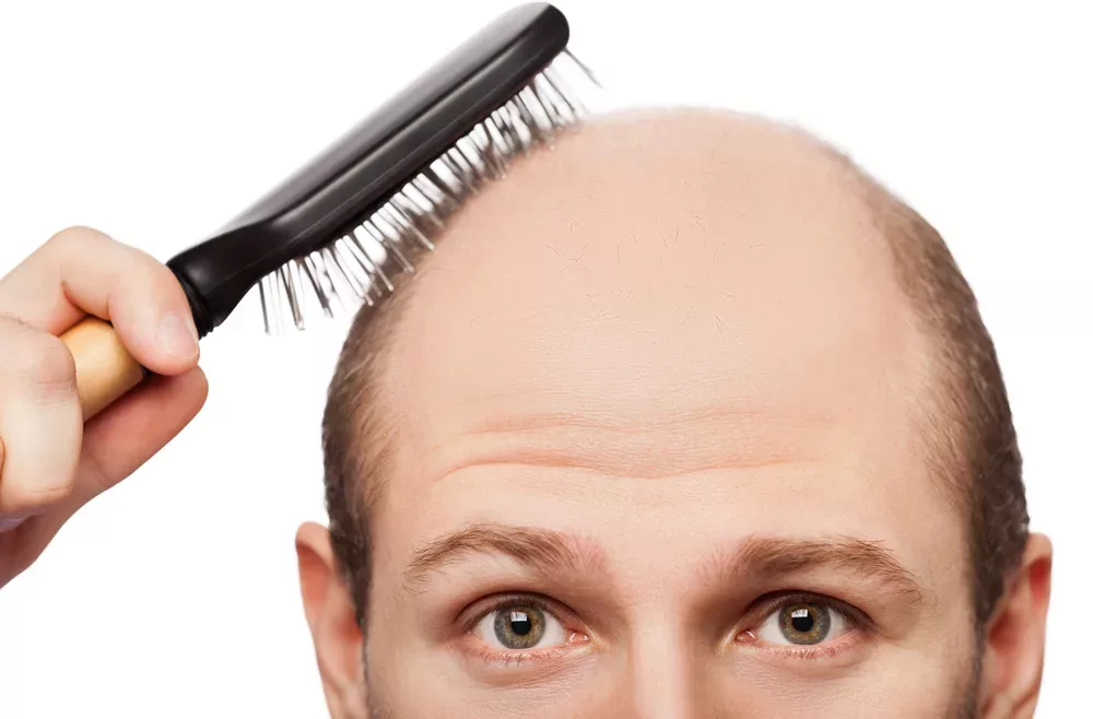 Wie man Haarausfall auf natürliche Weise stoppt