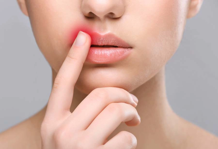 Natürliche Heilmittel für Lippenherpes