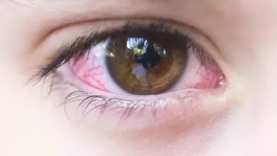 Pink-Eye-Closeup