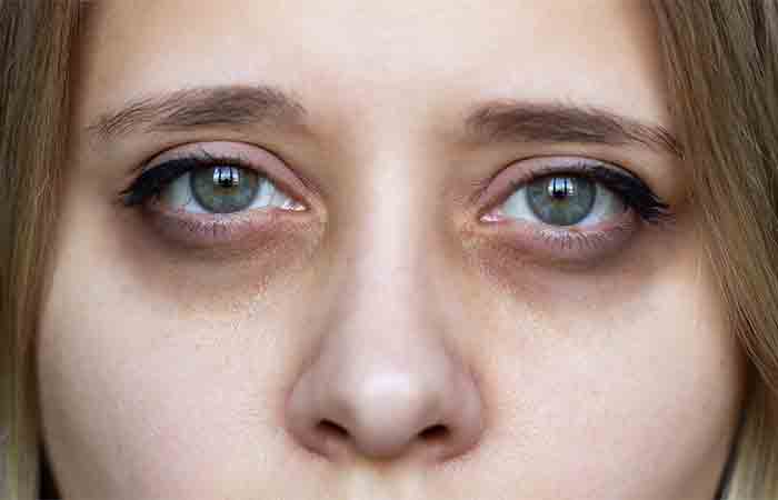 5 natürliche Hausmittel gegen Augenringe