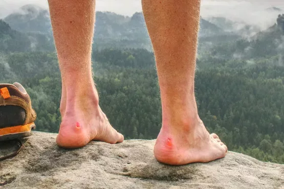 Sollte man eine Blase aufmachen?