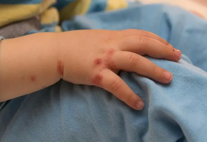 10 unglaubliche Hausmittel gegen Hand-Mund-Fuß-Krankheit, die Sie kennen sollten