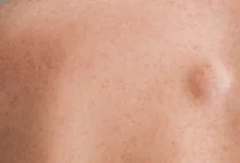 lipome