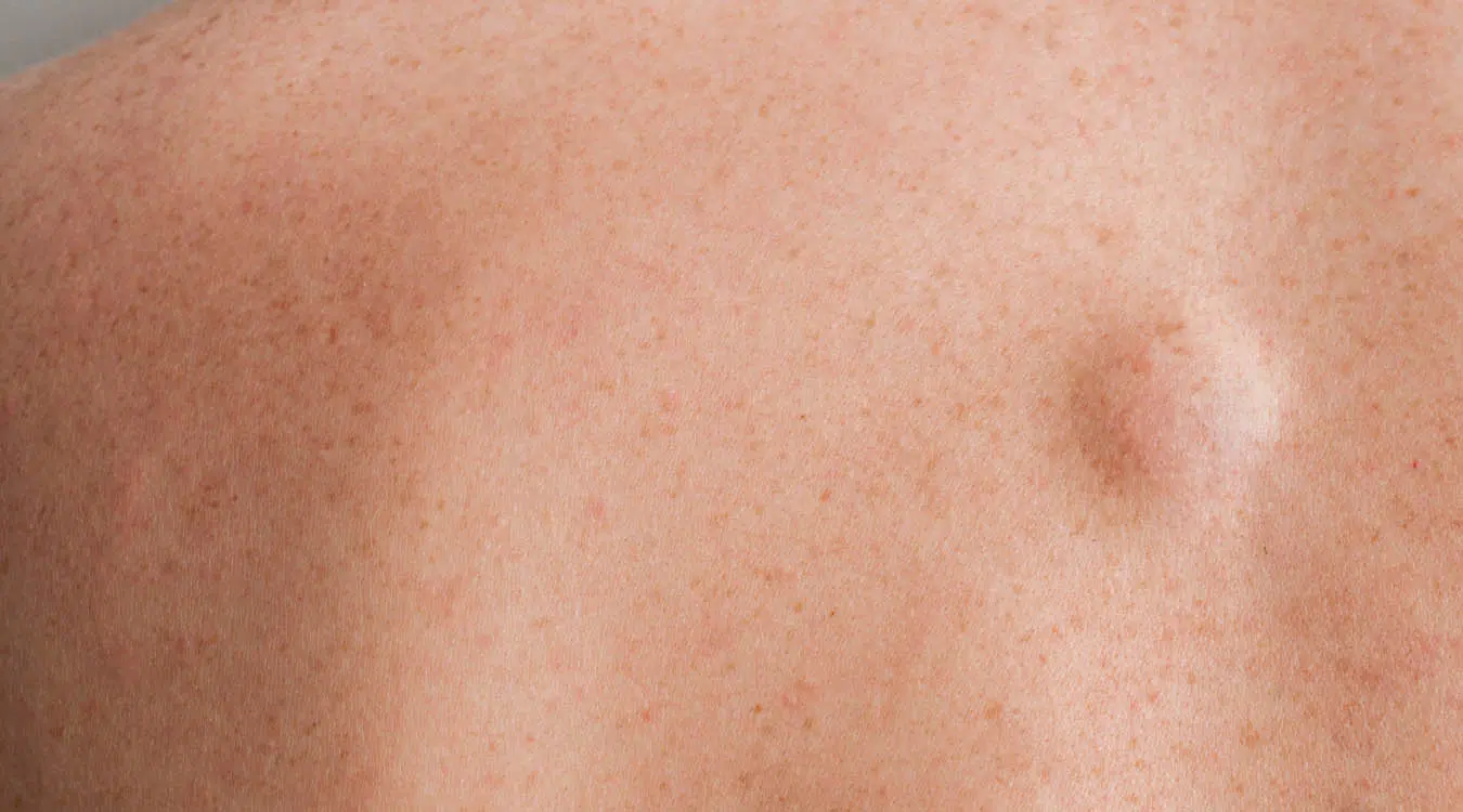 10 unglaubliche Hausmittel gegen Lipome, die Sie kennen sollten