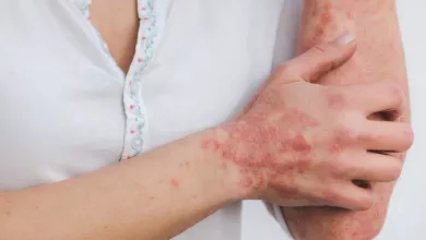 psoriasis-g41ef72080_1280