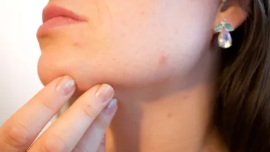 acne-g123830a49_1280