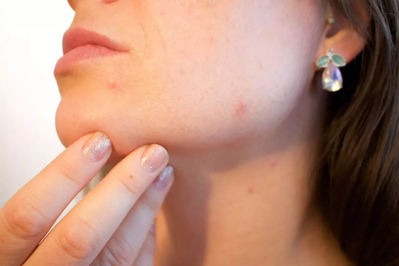 5 ayurvedische Hausmittel gegen Akne