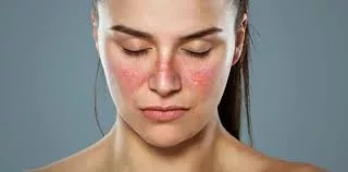 Lupus