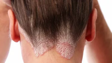 psoriasis-scalp-722x406-1