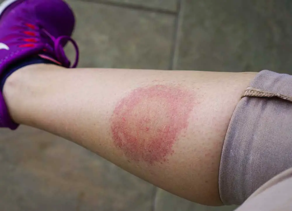 Johns-Hopkins-Studie: 7 Kräuter können Lyme-Bakterien abtöten und herkömmliche Behandlungen übertreffen