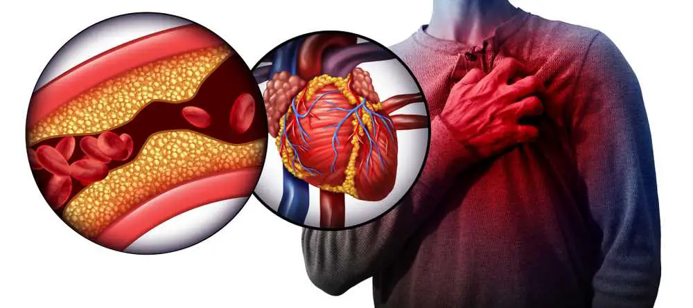 Warnsignale erkennen: Anzeichen für arterielle Verstopfungen