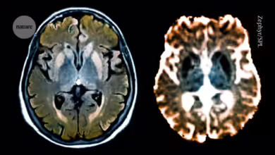 ‘Epigenome editor’ silences gene that causes deadly brain disorders