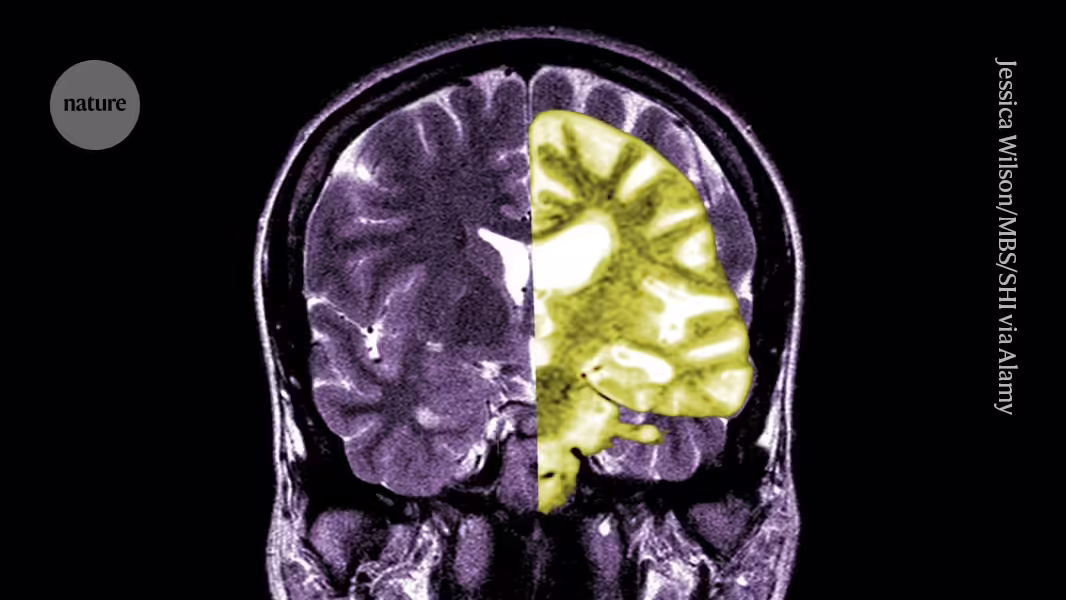 Debatte um das Alzheimer-Medikament Lecanemab, da UK Zulassung begrenzt